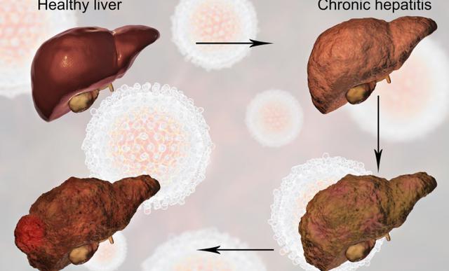 医生提醒：身体会出现4个&quot;怪像&quot;，或许是肝在变硬，劝你早检查