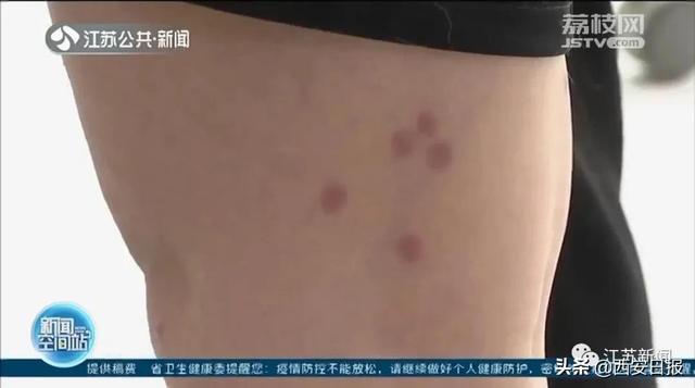 叮咬|清明出游后腿上多了几个红斑，医生紧急提醒：千万小心它，可致命