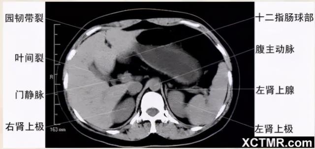 影像解剖：胸、腹部、盆腔CT解剖