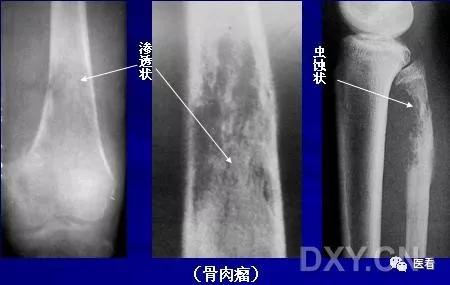 9个骨肿瘤医学影像诊断分析基本要点，如此精彩怎能错过