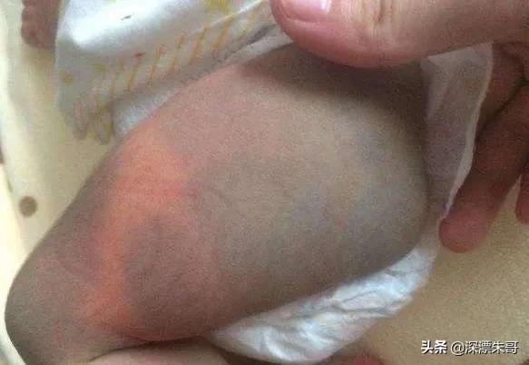超级宝妈|宝宝屁股上的“淤青”是什么？长着长着还会消失