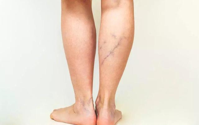 下肢|“小蚯蚓”亦可引发大问题 警惕“美腿杀手”下肢静脉曲张