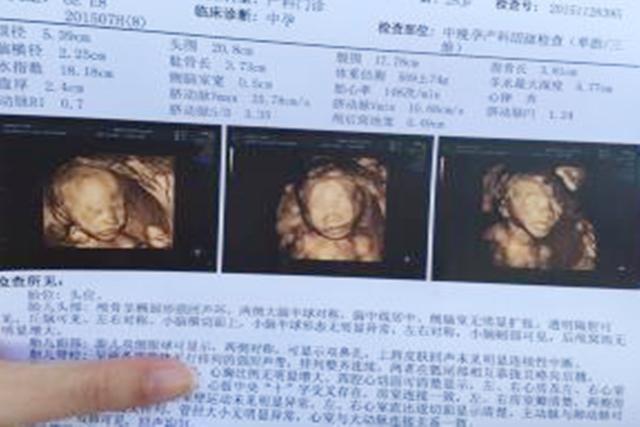 超级宝妈:国外产妇生出“无脸”婴儿,只因为孕期的这个做法,孕妈不忽视!