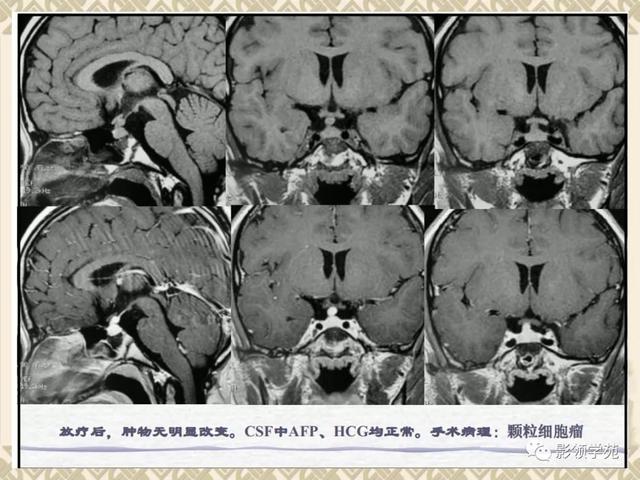 垂体病变的MRI诊断