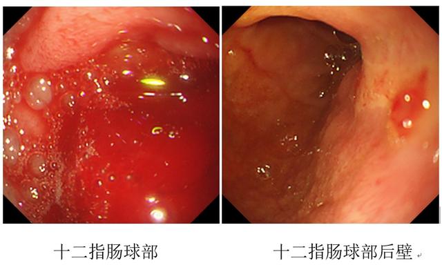 胃镜|7岁男孩腹痛20天，血色素仅3g！只因家长拒绝做这样一件事……