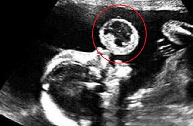 「超级宝妈」产检看到宝宝“吐泡泡”,准妈妈被萌化了,医生:还是打掉吧