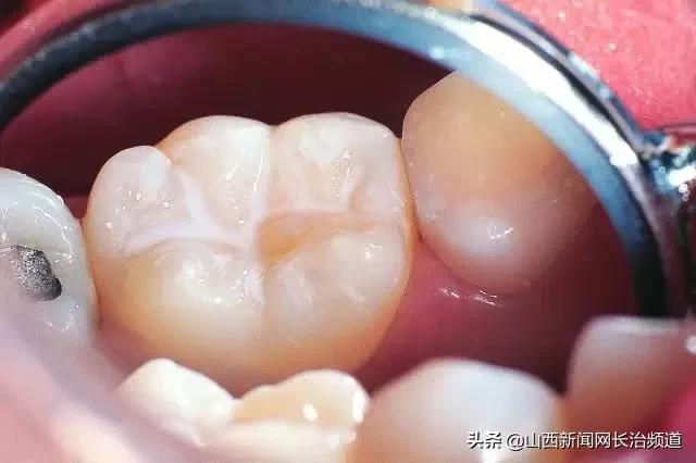 超级宝妈|长兴口腔六一儿童节福利，快带孩子来免费做窝沟封闭吧