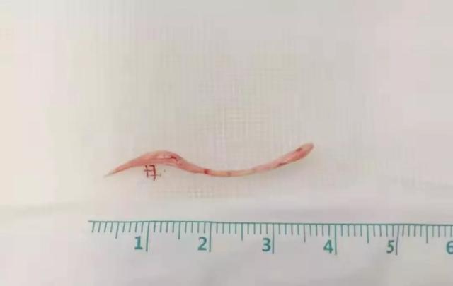 主动脉|10个科室30位专家参与大抢救，就因为一根鱼刺