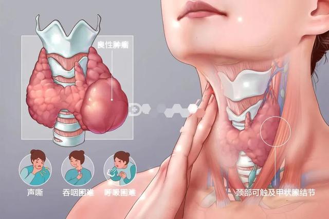 南阳医专一附院完成一例罕见巨大甲状腺肿瘤手术