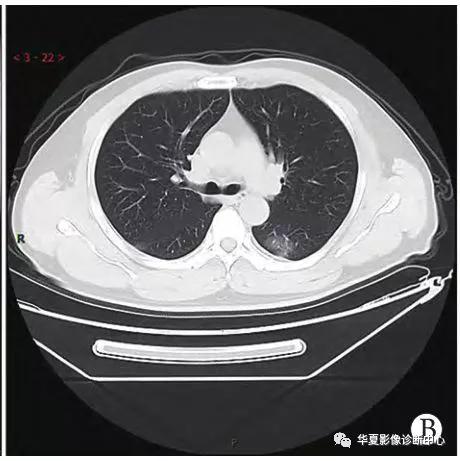「影像进展」新冠肺炎的CT典型和不典型表现以及影像学分期