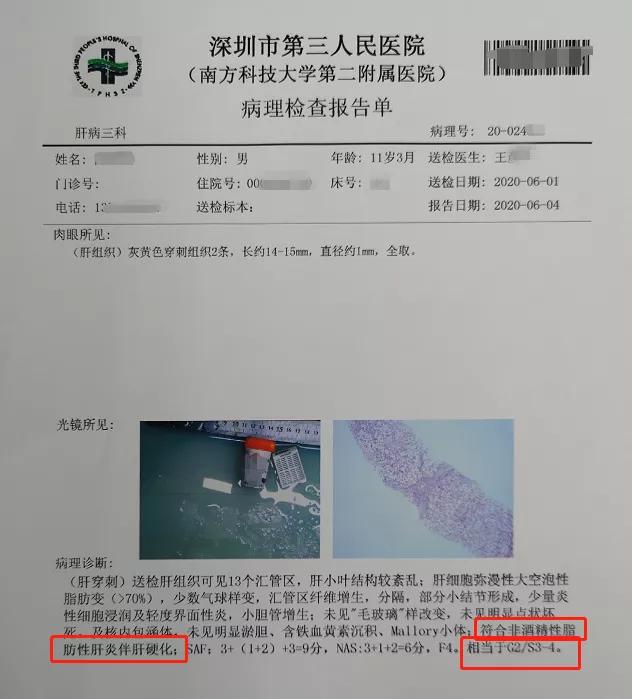 金牌大叔|11岁娃从小胃口好？被确诊重度肝硬化！竟和这“小事”有关