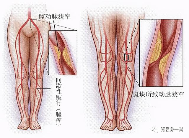 间接性跛行是腰椎椎管狭窄的症状