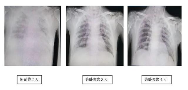 患者|“白肺”患者生命垂危，俯卧位通气治疗救命