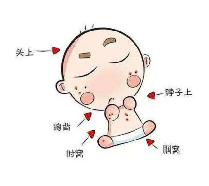 你的育儿经|健康日历 | 怎样全部武装起来，给宝宝防痱袪痱呢？