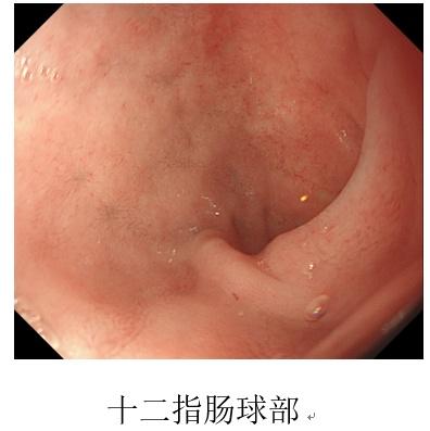 胃镜|7岁男孩腹痛20天，血色素仅3g！只因家长拒绝做这样一件事……