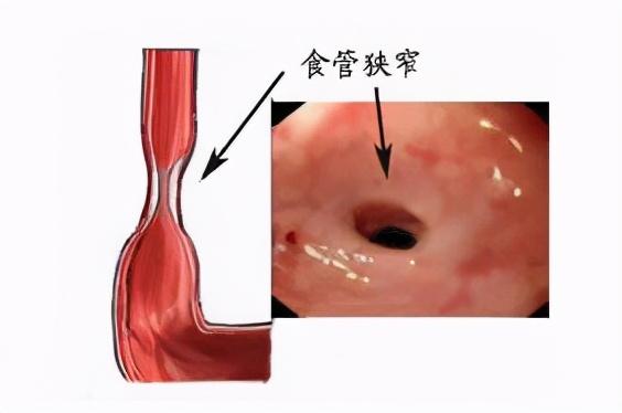 食管癌的癌前病变