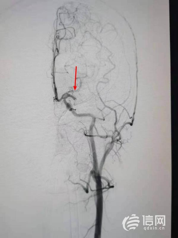平度首例脑动脉栓塞急症桥接手术 成功抢救16岁花季少女