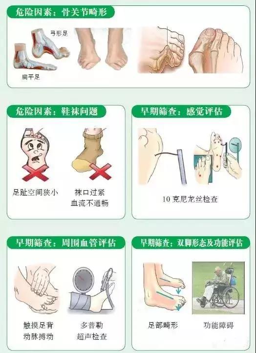 糖尿病|糖尿病人有四种症状，糖尿病足要发生了，防糖足看图