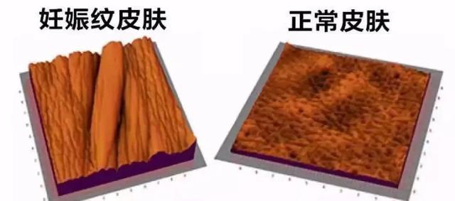 孕事生活|妊娠纹是怎么来的?