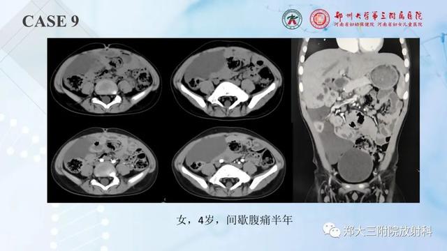 儿童腹部囊性病变诊断思路分析