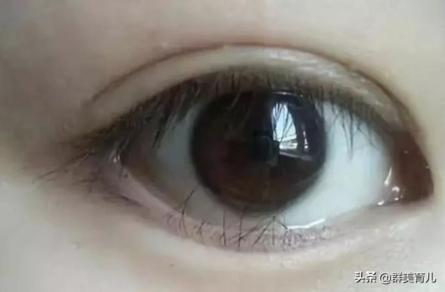 超级宝妈|宝妈给7岁女儿割双眼皮，看似是为了爱美，实际是为了根治倒睫