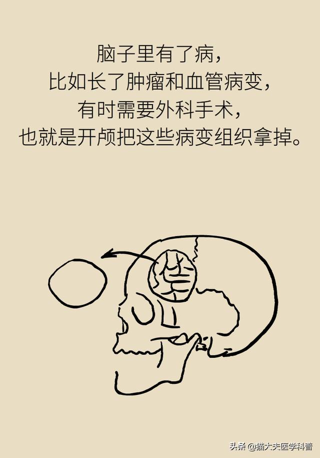 开颅手术就是“打开人的天灵盖”？我怀疑你是个古代人