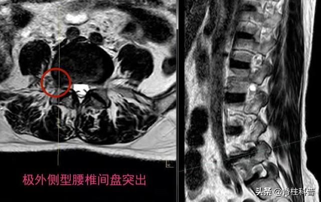 影像学|X光看不清，CT辐射大，腰突只想做最贵的核磁共振，为什么不行？