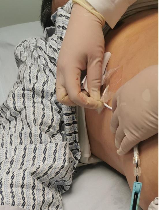 超声|胆囊炎急性发作却不能手术怎么办？这个方法为他赢得手术机会