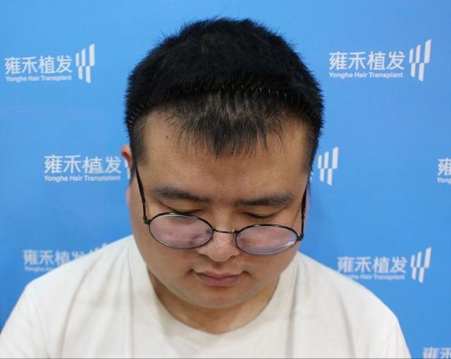 非那雄胺的真实有效率是多少（五位发友改善一年，终于告别稀疏）