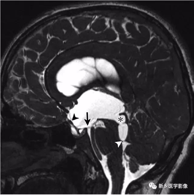 大脑中线处常见的25种疾病