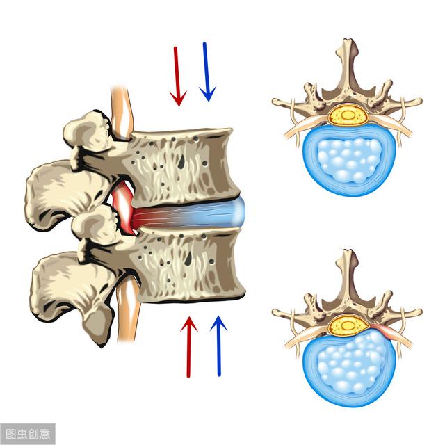 椎间盘|腰椎间盘突出当成骨质疏松治疗，居然治好了，真相是怎样呢？