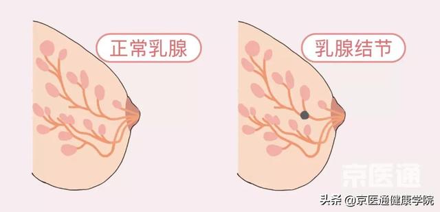 乳腺增生、结节、癌，摸起来什么感觉？医生教你分辨