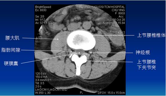 腰椎间盘CT诊断：椎间盘膨出、突出、椎管狭窄及退行性病变