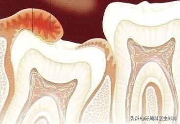 高考生家长们请关注：临考前最容易犯、且严重影响成绩的牙病