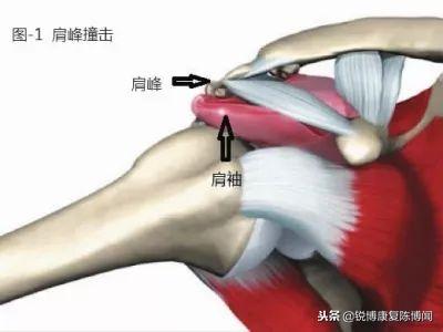 弹响|肩膀总是咔咔响？——别担心，快看这份解决秘籍！