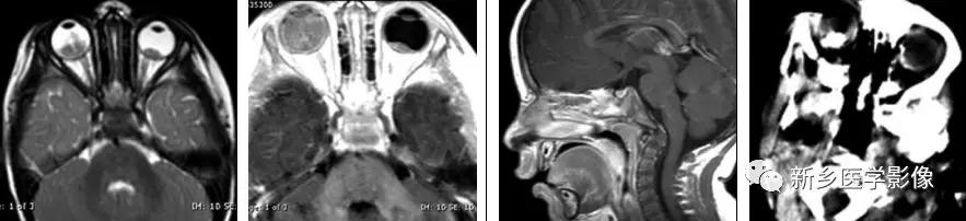 12种松果体区肿瘤的影像表现