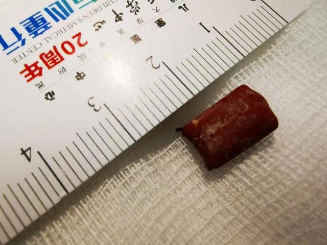异物|4岁男孩肺炎反复三个月不见好，CT显示呼吸要道竟被“金属脚”封堵