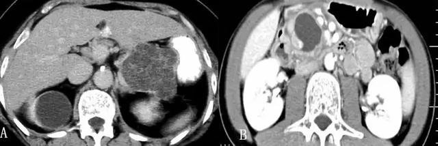 胰腺占位 CT 片不会看？这里一文教你掌握