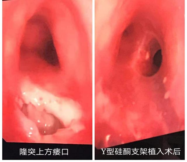 患者|想要自由呼吸？这个团队来帮您