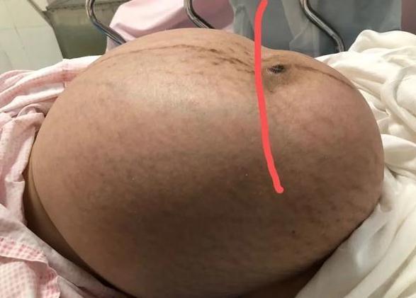 超级宝妈|19岁女孩怀孕8个月从未产检，肚里掏出6斤娃和30多斤巨瘤，命真大