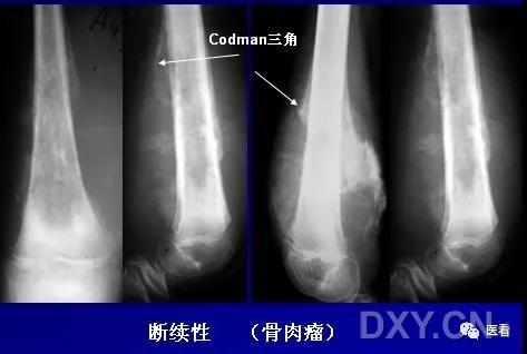 9个骨肿瘤医学影像诊断分析基本要点，如此精彩怎能错过