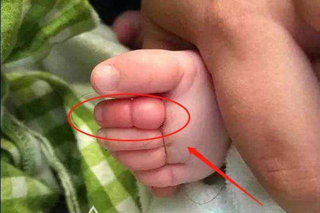 超级宝妈■6个月娃脚趾进“虫”，吓得宝妈赶紧带娃去医院，医生：还好及时