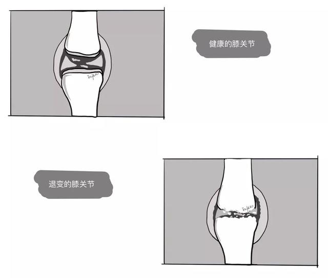 膝关节一活动，时不时传来“咔咔咔”的响声，需要治疗吗？