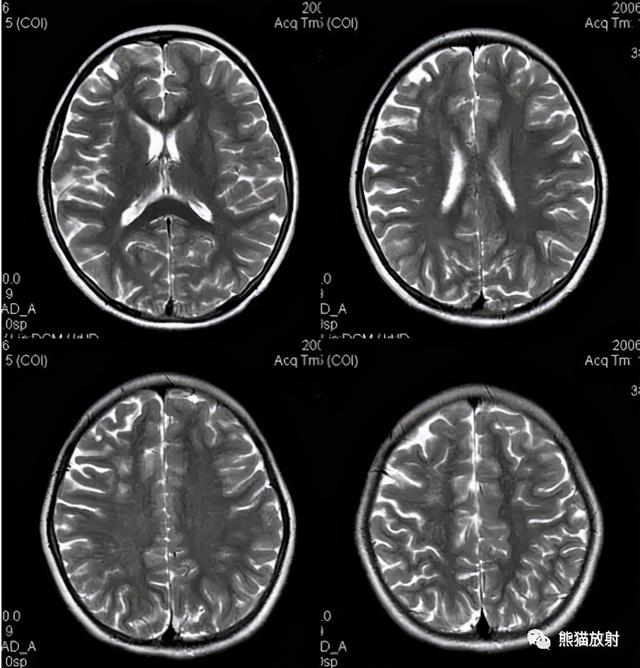 烟雾病的CT及MRI诊断