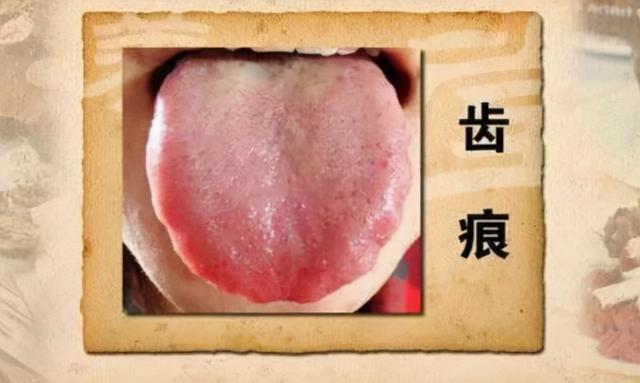 疲惫乏力，四肢沉重？多半是水湿痰饮在搞破坏！教你三招健脾化湿