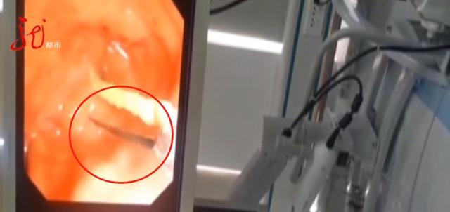 大庆一男子肚里藏了一根针，一半在胃里，一半在胃外！针孔上还有一根线