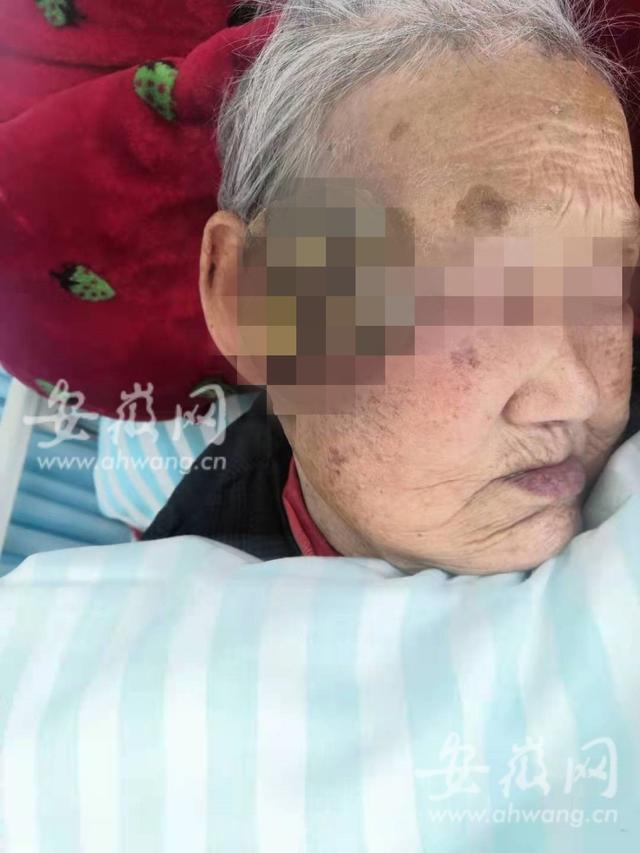 奶奶|九旬老人被肿瘤“吞”掉小半张脸 安医大四附院成功为其“换脸”