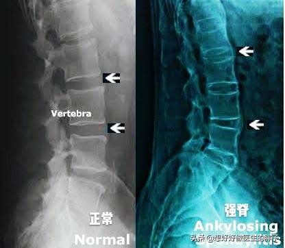 年轻男性、下背部疼痛，晨起加重活动缓解，要小心这个缠人的疾病