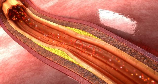 预防心肌梗死的关键，不是消除硬化斑块，而是增加斑块的稳定性