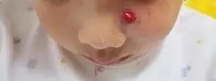 亲亲一家人|后悔！3岁男娃被鸡抓烂脸，伤口“长出”鸡趾甲